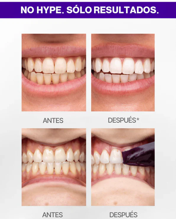 ¡Blanquea Tus Dientes Sensibles en Solo 7 Días Sin Dolor ni Peróxido!