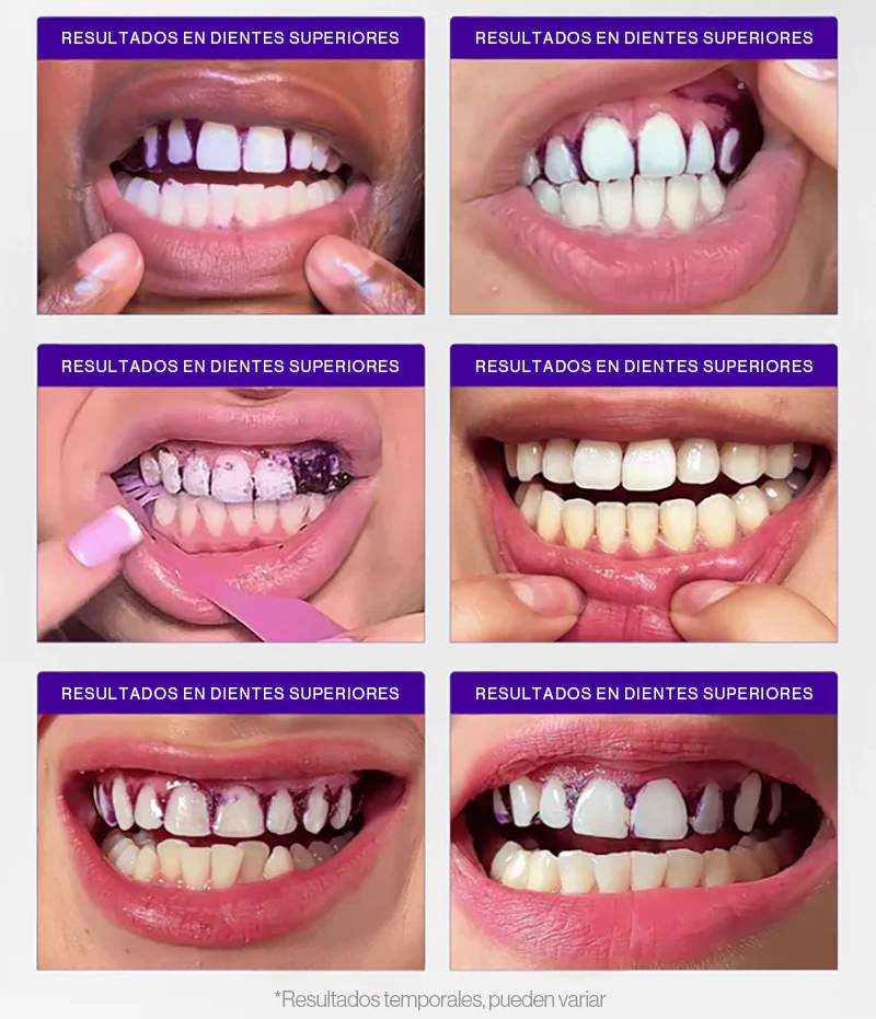 ¡Blanquea Tus Dientes Sensibles en Solo 7 Días Sin Dolor ni Peróxido!