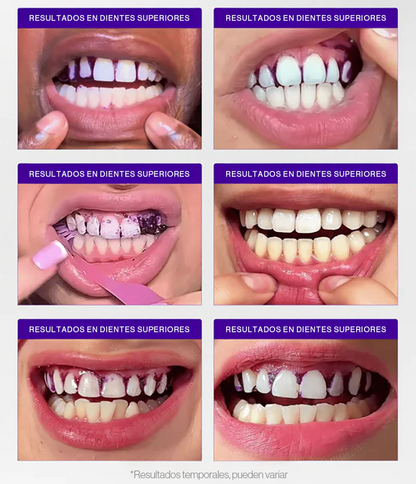 ¡Blanquea Tus Dientes Sensibles en Solo 7 Días Sin Dolor ni Peróxido!